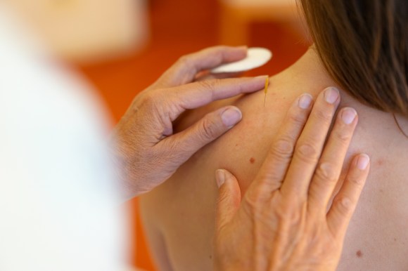 Nahaufnahme der Hände einer Physiotherapeutin, die Dry Needling an der linken Schulter einer Patientin durchführt.